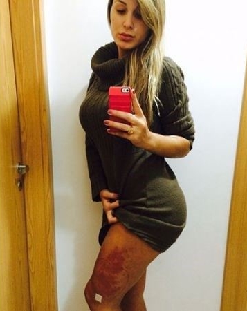 Em foto a vice Miss Bumbum mostra como ficou suas coxas (Reprodução: Internet)