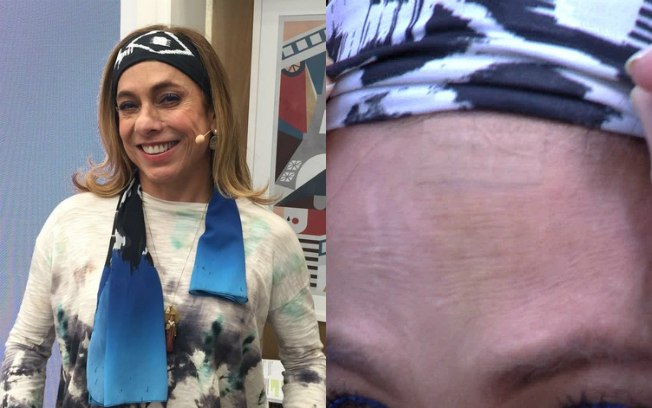 Cissa Guimarães sofre acidente doméstico e leva 15 pontos na cabeça