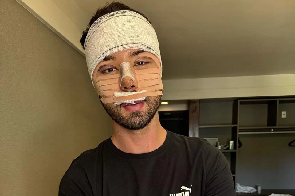 Rico Melquiades faz procedimento no rosto e internautas opinam: “Mudou nada”