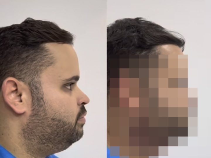 Michel, ex-“BBB24” faz lipo de papada e resultado não agrada: “Jogo dos 7 erros”