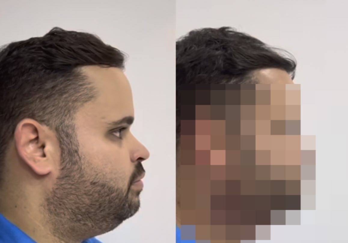 Michel, ex-“BBB24” faz lipo de papada e resultado não agrada: “Jogo dos 7 erros”