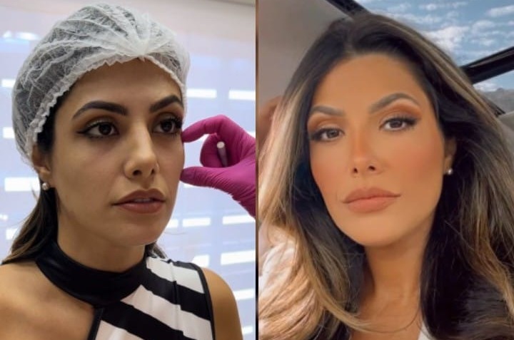 Mary Silvestre revela sua jornada de rejuvenescimento com harmonização facial