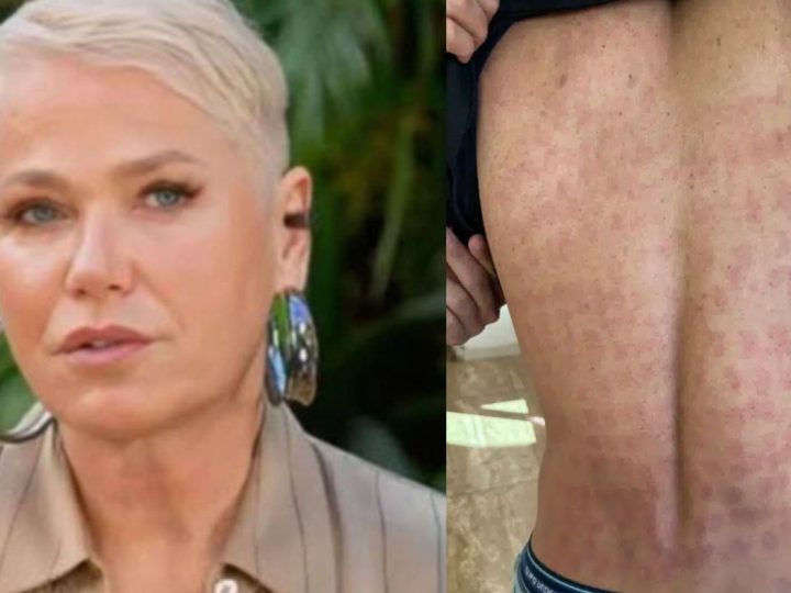 Empresa estética de Xuxa é acusada de causar queimaduras em clientes