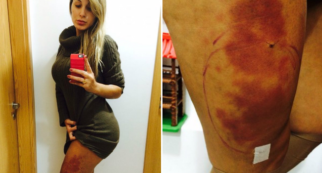 Fotos divulgadas por Andressa após a remoção do hidrogel através de uma lipoaspiração nas coxas.
