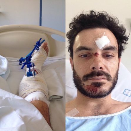 Kiko Pissolato sofre acidente de bicicleta: ‘Poderia ter morrido’
