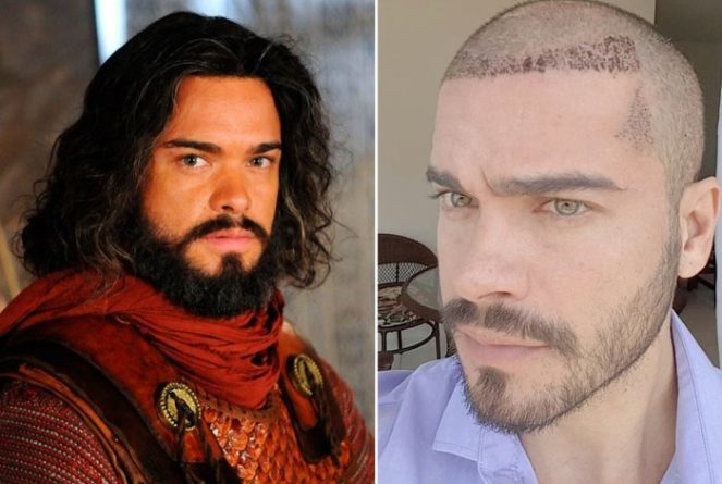 Sidney Sampaio faz implante capilar após personagem de novela deixá-lo careca; entenda
