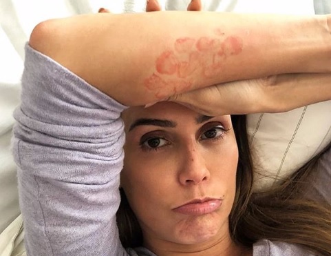 Deborah Secco explica o motivo das “manchas vermelhas” em seu braço