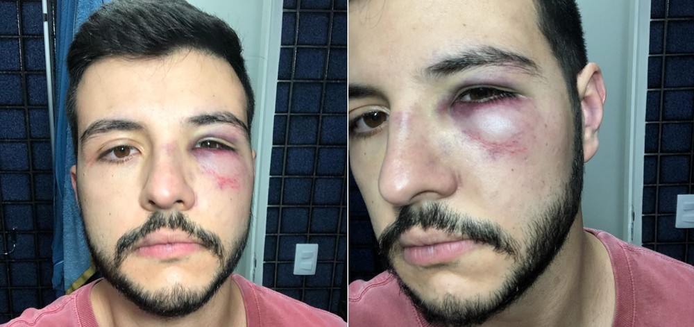 Apresentador da Record, Matheus Ribeiro é agredido na rua e exibe olho roxo