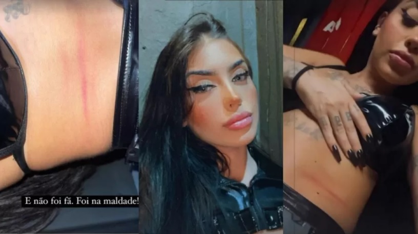 MC Mirella mostra as marcas da agressão pelo corpo