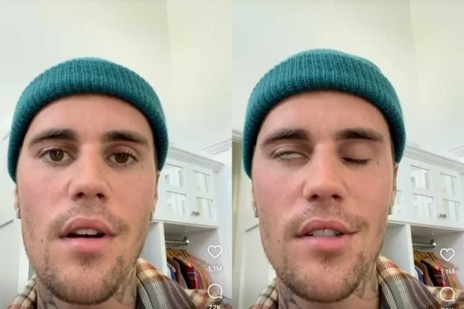 Após paralisia facial, estado de saúde de Justin Bieber é divulgado