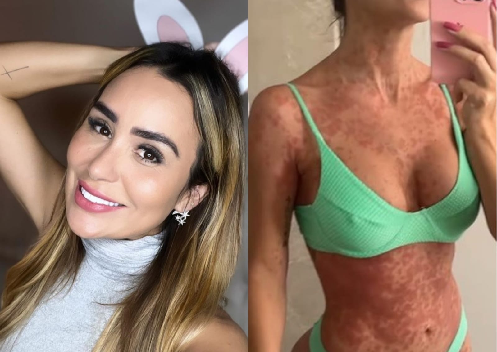 Ex-BBB Letícia Santiago descobre doença após manchas vermelhas na pele
