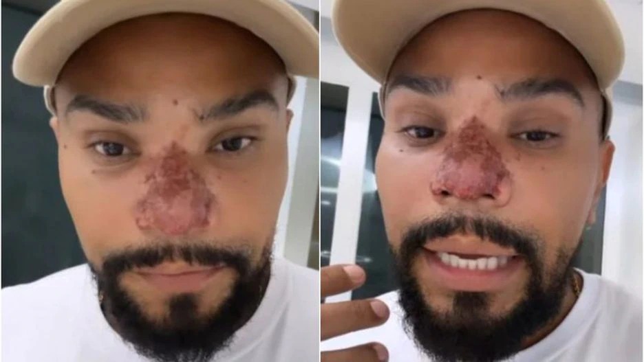 Naldo Benny sofre princípio de necrose no nariz e profissional explica o que aconteceu