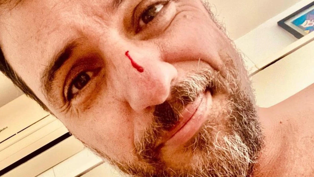 Rodrigo Lombardi surge todo arranhado, explica motivo e seguidores reagem: “Vai com calma”
