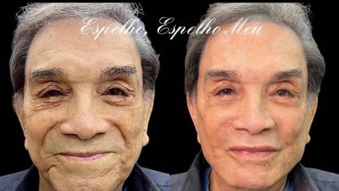 Harmonização facial de Dedé Santana choca e gera discussão