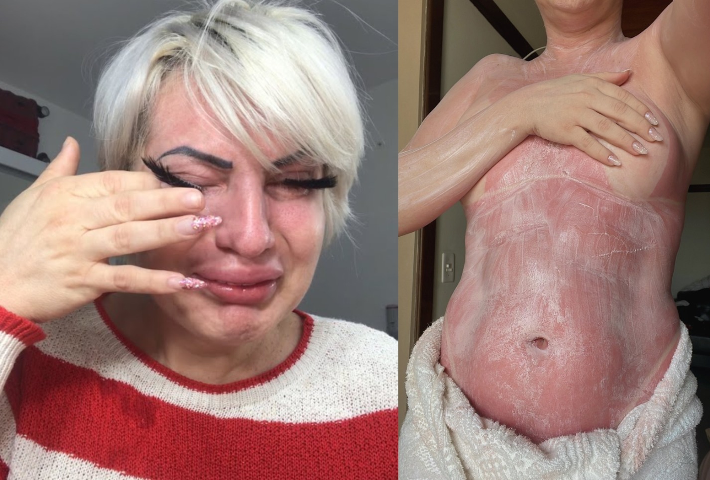 Humorista faz bronzeamento artificial e fica com a pele em carne viva