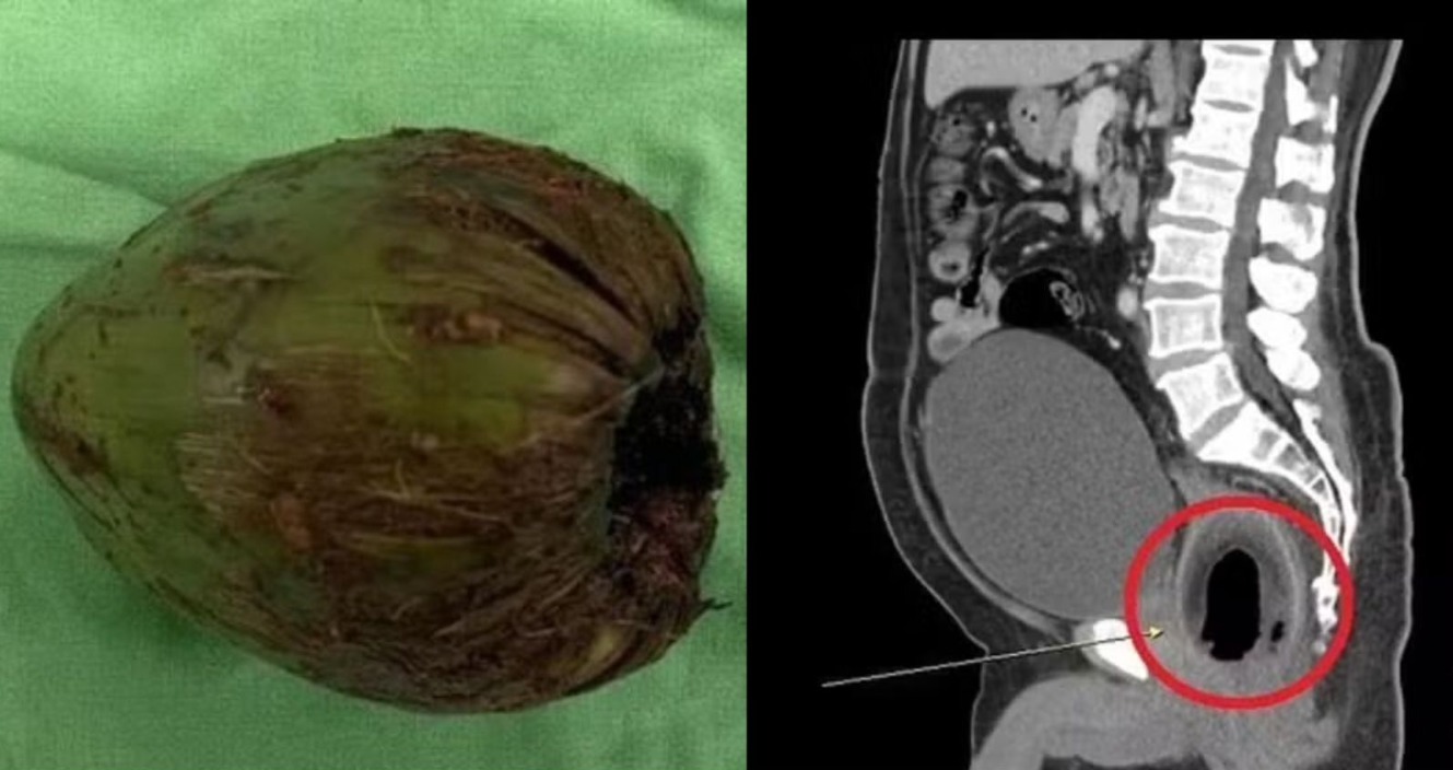 Homem tem coco preso no ânus, passa mal e é hospitalizado