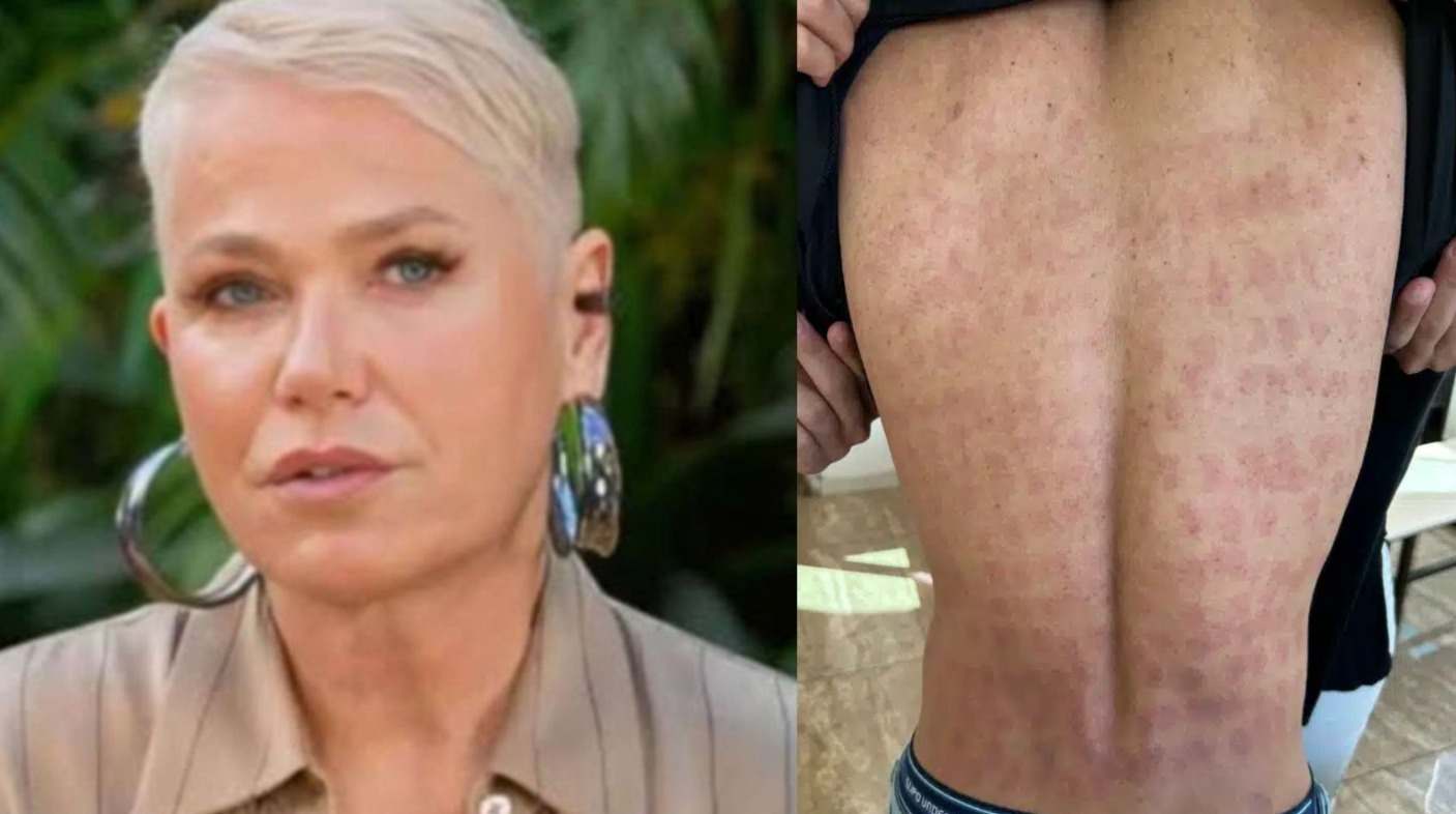 Empresa estética de Xuxa é acusada de causar queimaduras em clientes