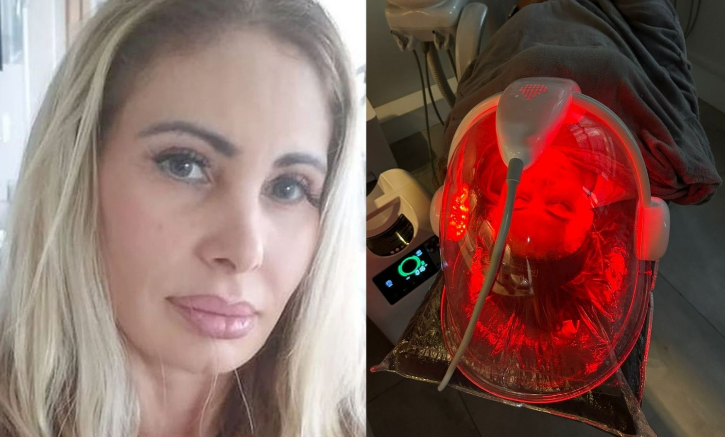 Ângela Bismarchi realiza procedimento de Lift Facial