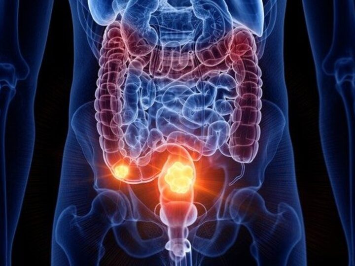 Câncer de intestino: sinais ignorados ainda atrasam diagnóstico no Brasil