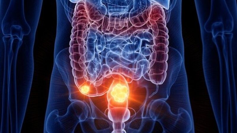 Câncer de intestino: sinais ignorados ainda atrasam diagnóstico no Brasil