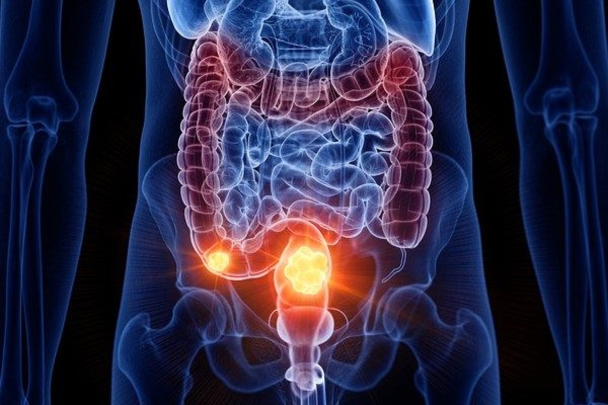 Câncer de intestino: sinais ignorados ainda atrasam diagnóstico no Brasil